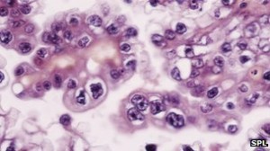ovarian_cancer-spl