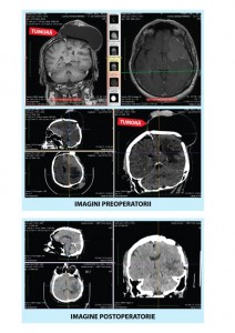 Pacient cu meningiom cerebral recidivat operat cu succes dupa ce a fost calificat ca fiind "inoperabil"
