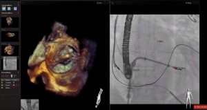 Premiera medicala: trei copii operati pe cord inchis printr-o tehnologie 3D