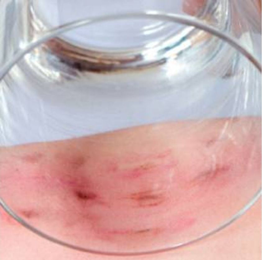 Dr. Mihai Craiu avertizează: "Un semn pe care ar trebui să îl știe toți părinții!". Ar putea fi foarte grav: „de obicei meningită sau septicemie”